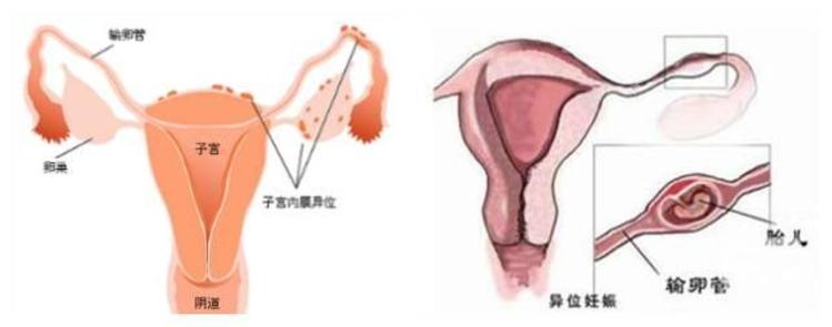 人工受精代孕
